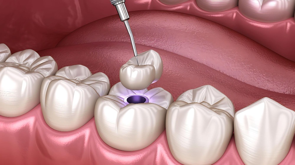 dental-sealants-chennai-thangams-dental-clinic